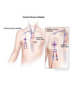 Central Venous Catheter